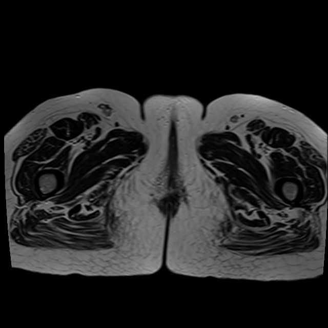Bilateral tubo-ovarian abscesses (Radiopaedia 58635-65829 Axial T2 52).jpg