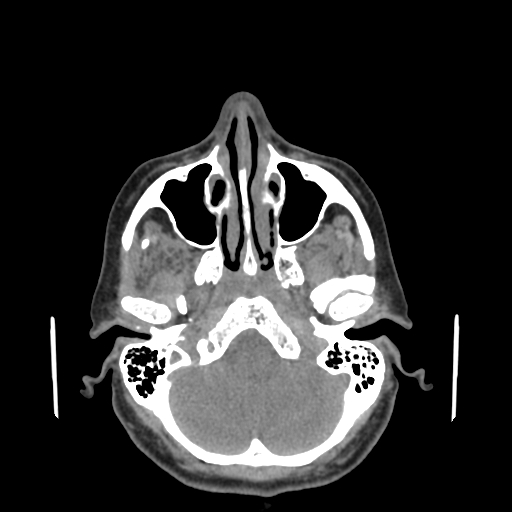 File:Bisphosphonate-related osteonecrosis of the jaw (Radiopaedia 71324-81642 non-contrast 148).jpg