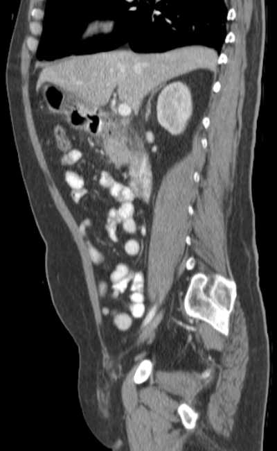Bleeding duodenal ulcer and adenomyomatosis of gallbladder (Radiopaedia 61834-69861 C 39).jpg