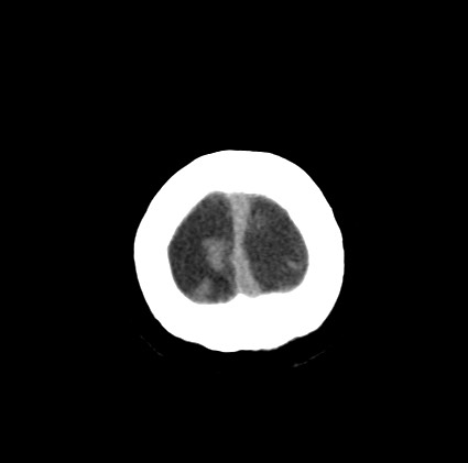File:Blood on the tentorium simulating hyperdense transverse sinus (Radiopaedia 55521-61991 Axial non-contrast 49).jpg