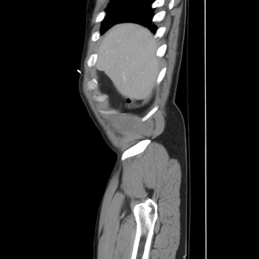 File:Blunt abdominal trauma with solid organ and musculoskelatal injury with active extravasation (Radiopaedia 68364-77895 C 28).jpg