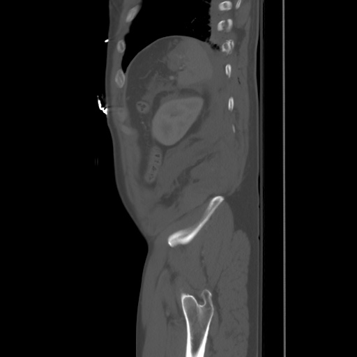 Blunt abdominal trauma with solid organ and musculoskelatal injury with active extravasation (Radiopaedia 68364-77895 Sagittal bone window 94).jpg