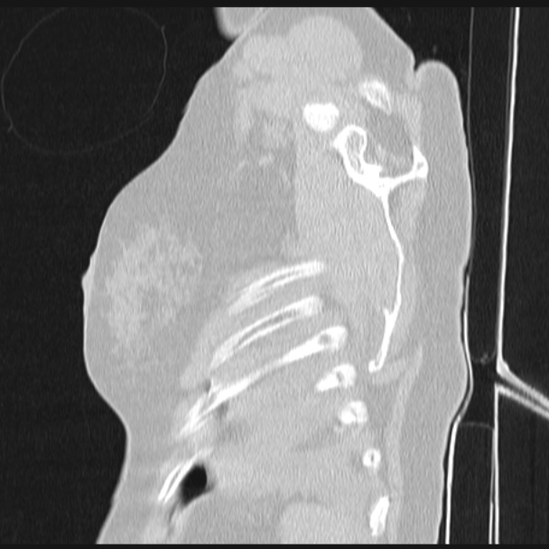Boerhaave syndrome (Radiopaedia 45644-49799 Sagittal lung window 81).jpg