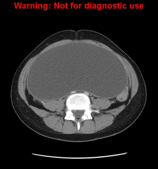 Borderline mucinous cystadenoma of ovary (Radiopaedia 25586-25767 A 54).jpg