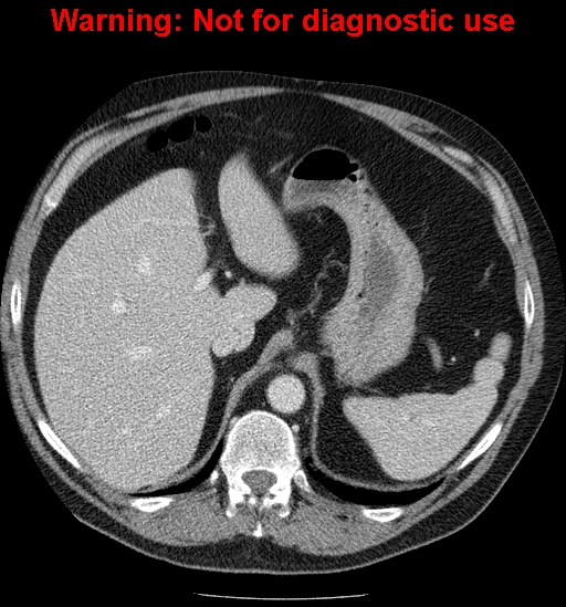 File:Bosniak renal cyst - type IV (Radiopaedia 23402-23466 D 14).jpg