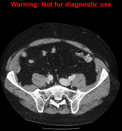 File:Bosniak renal cyst - type IV (Radiopaedia 23402-23466 D 58).jpg