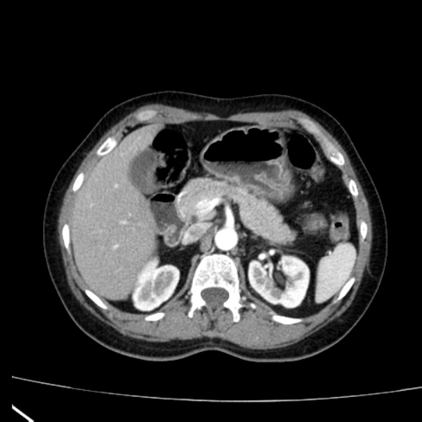 Bosniak renal cyst - type I (Radiopaedia 27479-27675 renal cortical phase 24).jpg