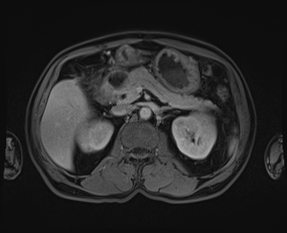Bouveret syndrome (Radiopaedia 61017-68856 Axial T1 C+ fat sat 36).jpg