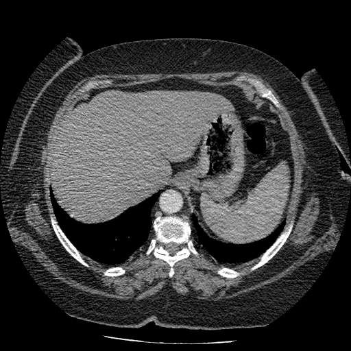 Bovine aortic arch - right internal mammary vein drains into the superior vena cava (Radiopaedia 63296-71875 A 146).jpg