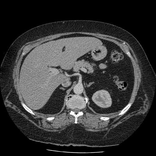 Bovine aortic arch - right internal mammary vein drains into the superior vena cava (Radiopaedia 63296-71875 A 186).jpg