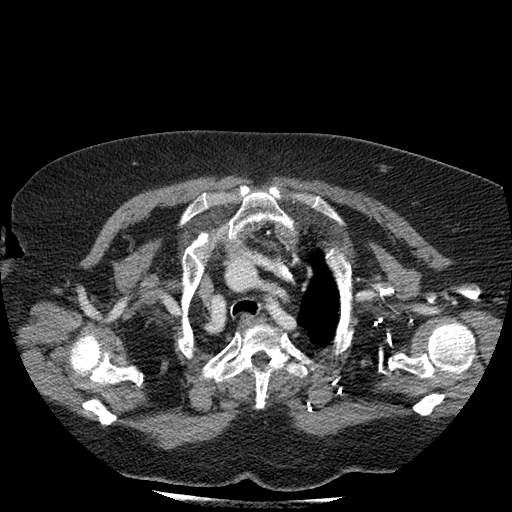 Bovine aortic arch - right internal mammary vein drains into the superior vena cava (Radiopaedia 63296-71875 A 21).jpg