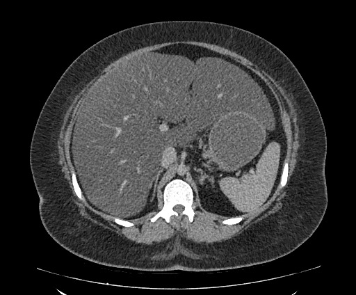 File:Bowel and splenic infarcts in acute lymphocytic leukemia (Radiopaedia 61055-68913 A 44).jpg