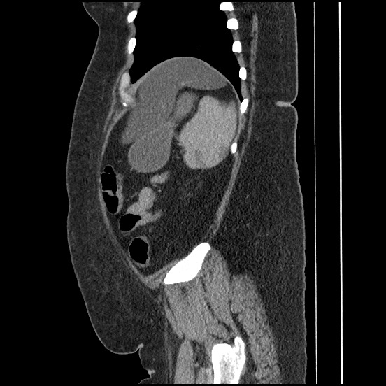 Bowel and splenic infarcts in acute lymphocytic leukemia (Radiopaedia 61055-68913 C 22).jpg