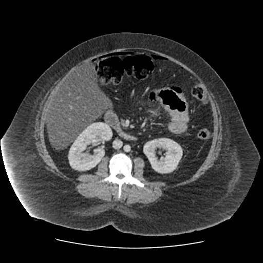 File:Bowel and splenic infarcts in acute lymphocytic leukemia (Radiopaedia 61055-68915 A 67).jpg