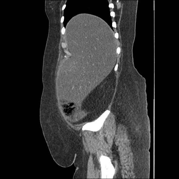 Bowel and splenic infarcts in acute lymphocytic leukemia (Radiopaedia 61055-68915 C 54).jpg