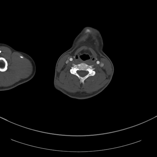 Brachiocephalic trunk pseudoaneurysm (Radiopaedia 70978-81191 Axial bone window 22).jpg