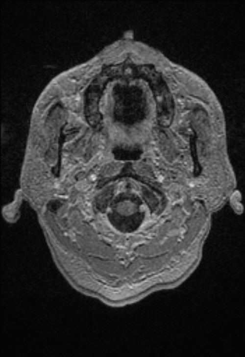 Brain abscess with ventriculitis (Radiopaedia 85703-101495 Axial T1 C+ 13).jpg