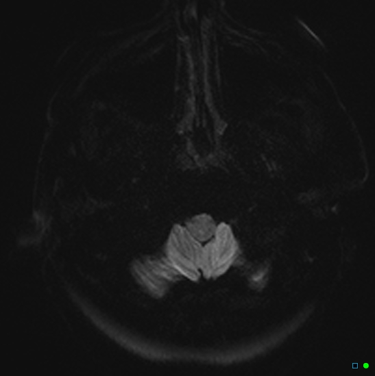 File:Brain death on MRI and CT angiography (Radiopaedia 42560-45689 Axial DWI 1).jpg