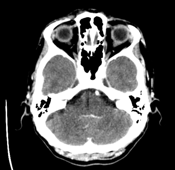 File:Brain metastases from lung cancer (Radiopaedia 24480-24781 Axial C+ delayed 11).jpg
