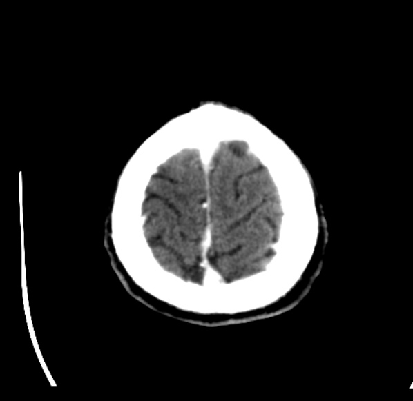 File:Brain metastases from lung cancer (Radiopaedia 24480-24781 Axial C+ delayed 58).jpg
