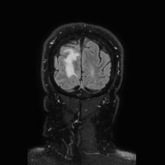 Brain metastases from lung cancer (Radiopaedia 83839-99028 Coronal FLAIR 77).jpg