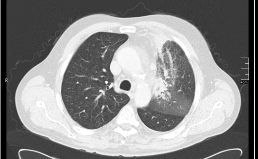 Brain metastases from squamocellular lung cancer (Radiopaedia 56515-63219 Axial lung window 25).jpg