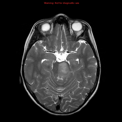File:Brainstem glioma (Radiopaedia 9444-10124 Axial T2 8).jpg