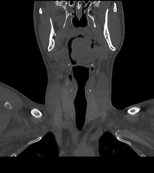 File:Branchial cleft cyst (Radiopaedia 31167-31875 Coronal bone window 29).jpg