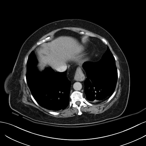 File:Breast carcinoma with pathological hip fracture (Radiopaedia 60314-67974 B 7).jpg