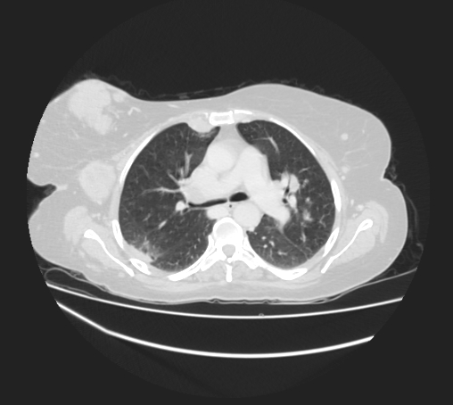 Breast metastases from facial malignant melanoma (Radiopaedia 60316-67975 Axial lung window 42).jpg