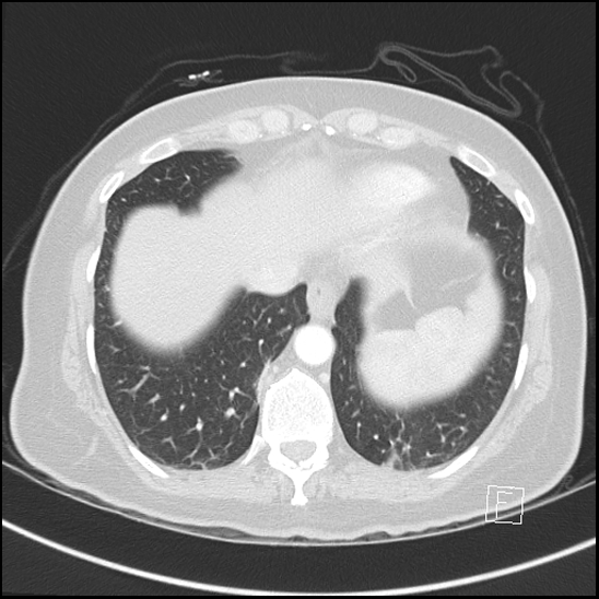 Breast metastases from renal cell cancer (Radiopaedia 79220-92225 Axial lung window 69).jpg