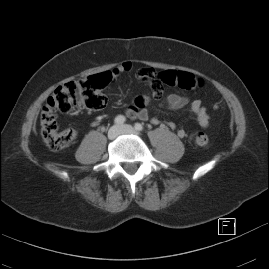 File:Breast metastases from renal cell cancer (Radiopaedia 79220-92225 C 70).jpg