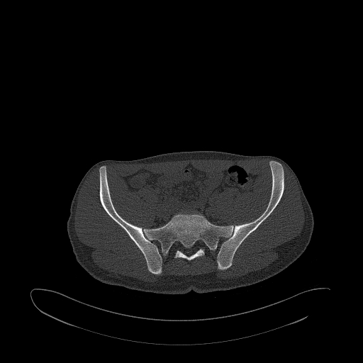 Brodie abscess- femoral neck (Radiopaedia 53862-59966 Axial bone window 43).jpg