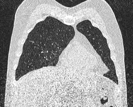 Bronchial atresia (Radiopaedia 58271-65417 Coronal lung window 11).jpg