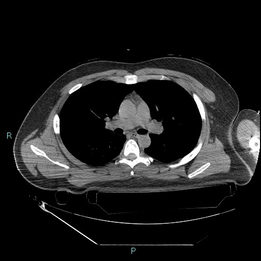 Bronchial carcinoid tumor (Radiopaedia 78272-90870 Axial non-contrast 44).jpg