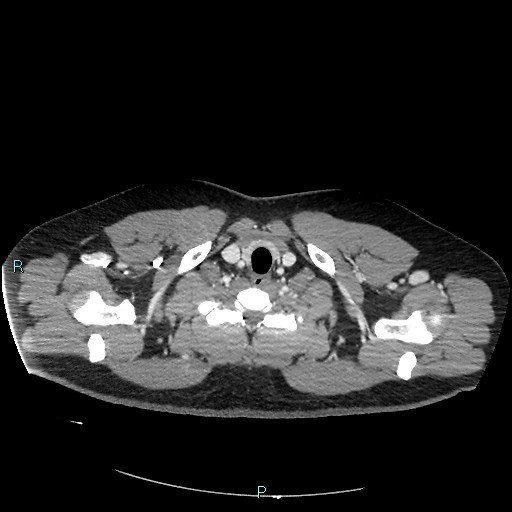 Bronchial carcinoid tumor (Radiopaedia 78272-90875 A 12).jpg