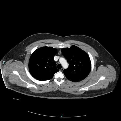 Bronchial carcinoid tumor (Radiopaedia 78272-90875 A 31).jpg