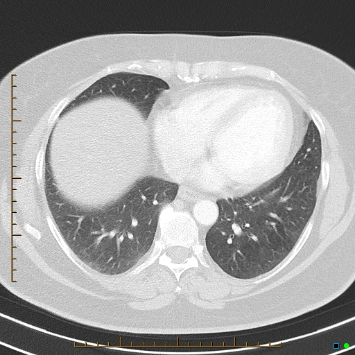 Bronchial diverticula (Radiopaedia 79512-92675 Axial lung window 34).jpg