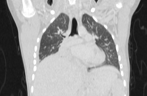 Bronchial mucoepidermoid carcinoma (Radiopaedia 57023-63895 Coronal lung window 12).jpg