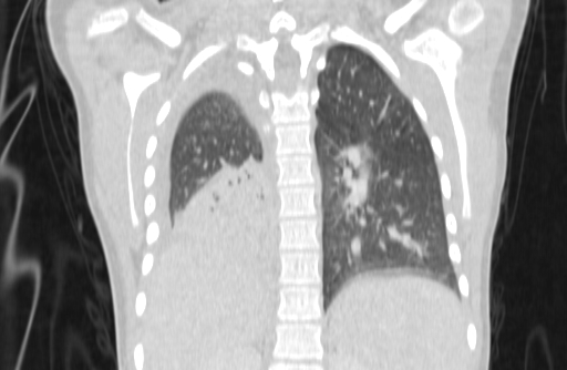 Bronchial mucoepidermoid carcinoma (Radiopaedia 57023-63895 Coronal lung window 61).jpg