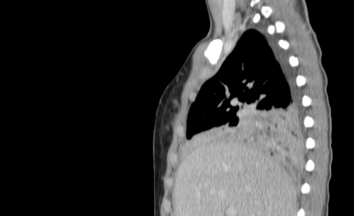 Bronchial mucoepidermoid carcinoma (Radiopaedia 57023-63895 Sagittal 64).jpg