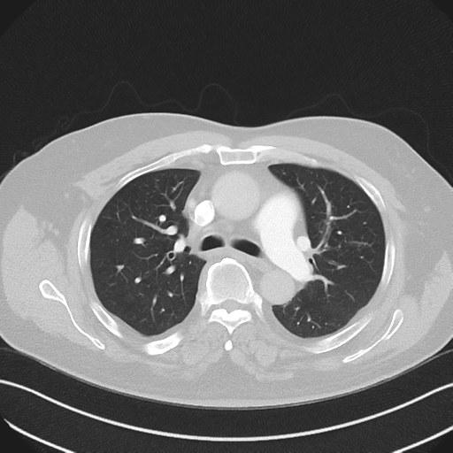 File:Bronchiectasis (Radiopaedia 39385-41666 Axial lung window 26).png