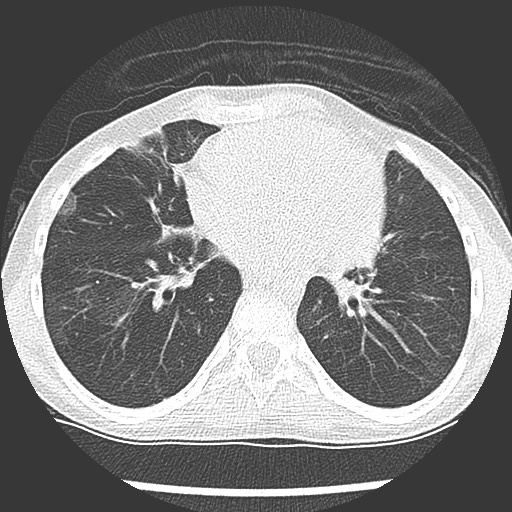 Bronchiolotis obliterans (Radiopaedia 73769-84575 Axial lung window 29).jpg