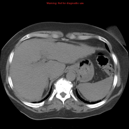 Bronchoalveolar carcinoma (Radiopaedia 13224-13233 Axial non-contrast 39).jpg