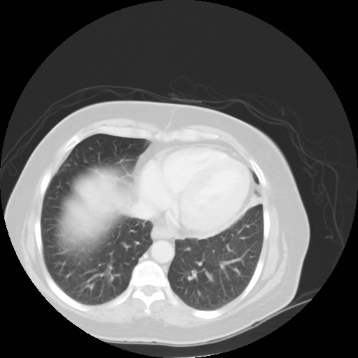 Bronchogenic carcinoma (Radiopaedia 73497-84262 Axial lung window 47).jpg