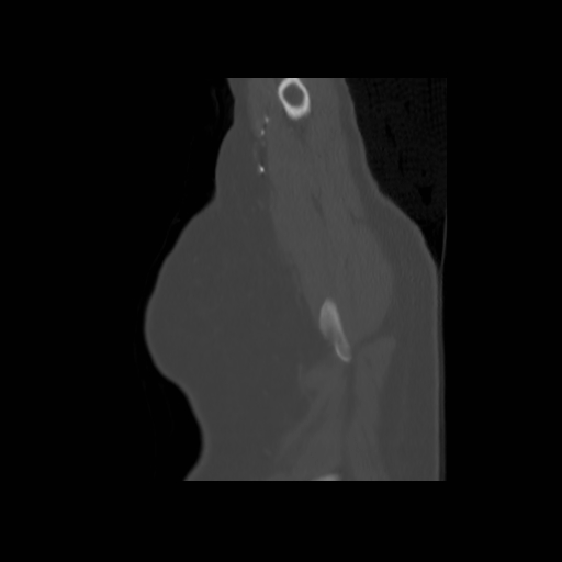 Bronchogenic carcinoma (Radiopaedia 73497-84262 Sagittal bone window 15).jpg