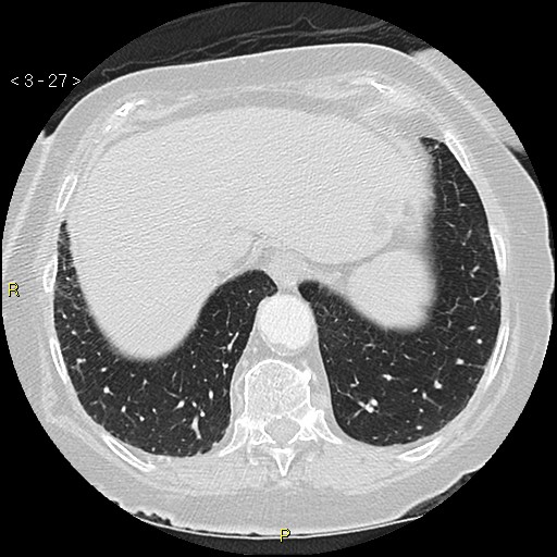 Bronchogenic carcinoma as an incidental finding (Radiopaedia 16453-16130 Axial lung window 27).jpg