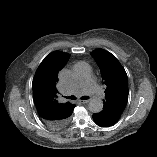 Bronchogenic carcinoma with metastatic lymphadenopathy (Radiopaedia 37671-39569 Axial non-contrast 23).jpg