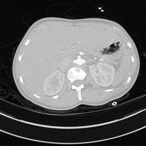 File:Bronchogenic cyst (Radiopaedia 77801-90071 Axial lung window 90).jpg
