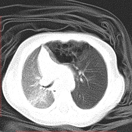 Bronchogenic cyst (Radiopaedia 78599-91409 Axial lung window 58).jpg